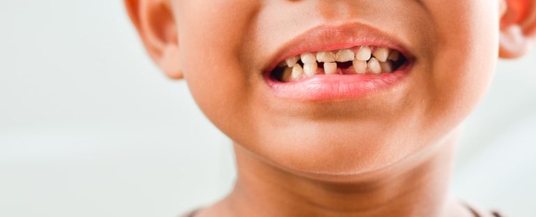 Smiling child with missing teeth