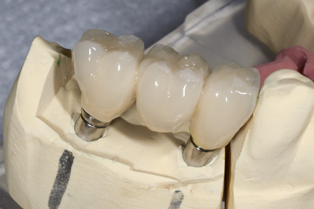 a sample of dental implant